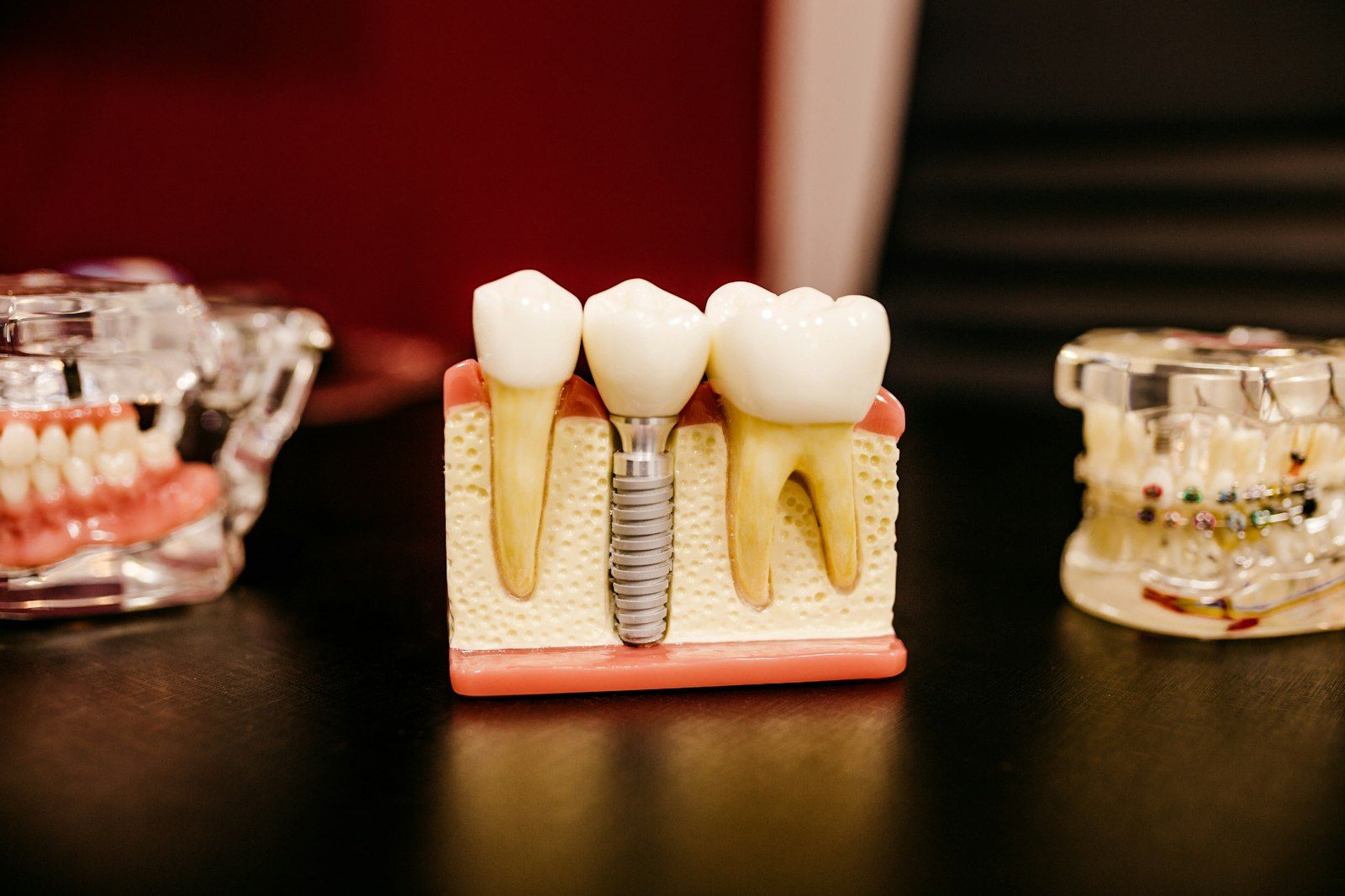 Gefertigte Implantatkronen auf einem Modell